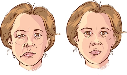 Facial Paralysis (Facial Paralysis)