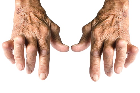 Rheumatoid Arthritis Information Form
