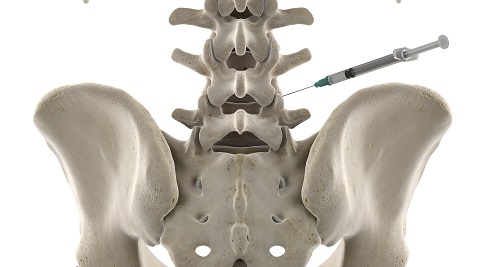 Spine Injections - PriformisSyndrome Injection